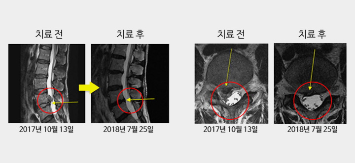 도침요법을 받은 요추 추간판 탈출증 환자의 치료 전후 MRI 사진 비교 결과
